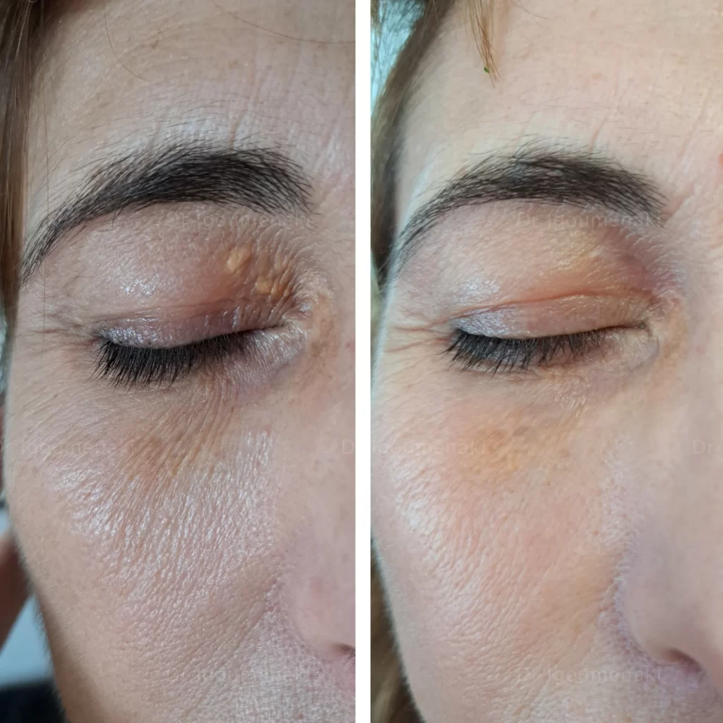 Blefaroplastica non Chirurgica Palpebre Cadenti Roma