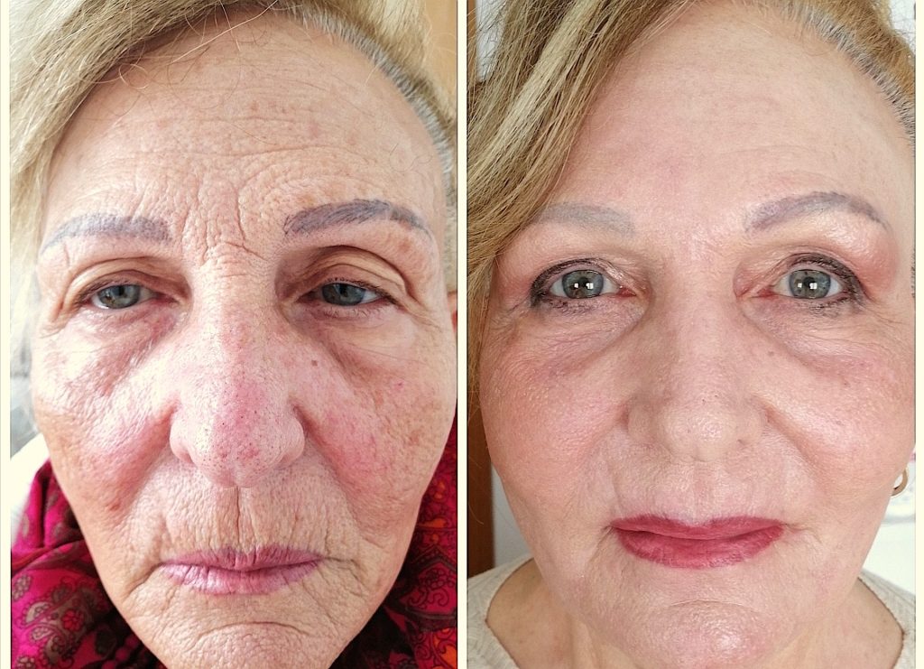 Blefaroplastica non chirurgica Roma