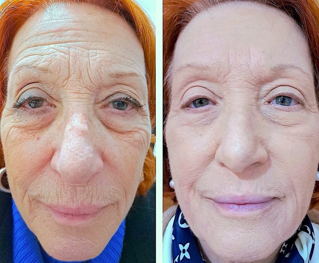 Lifting Non Chirurgico Roma