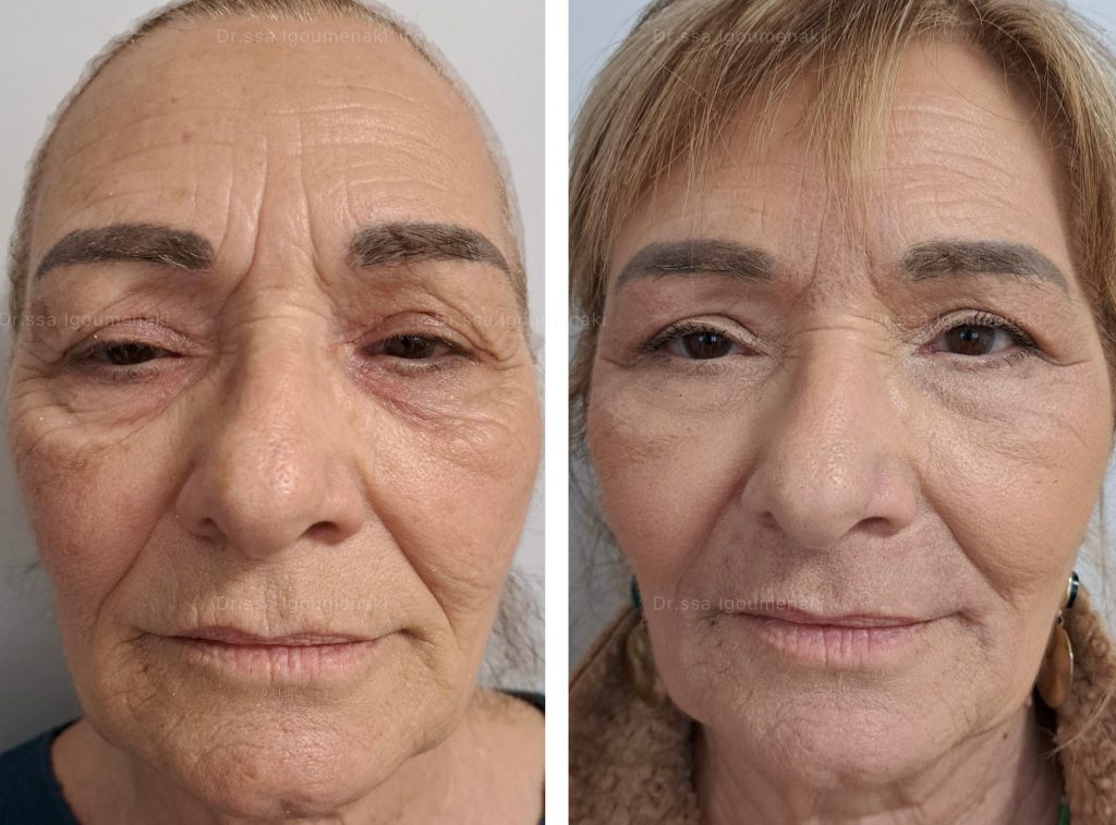 Vantaggi di una Blefaroplastica Non Chirurgica