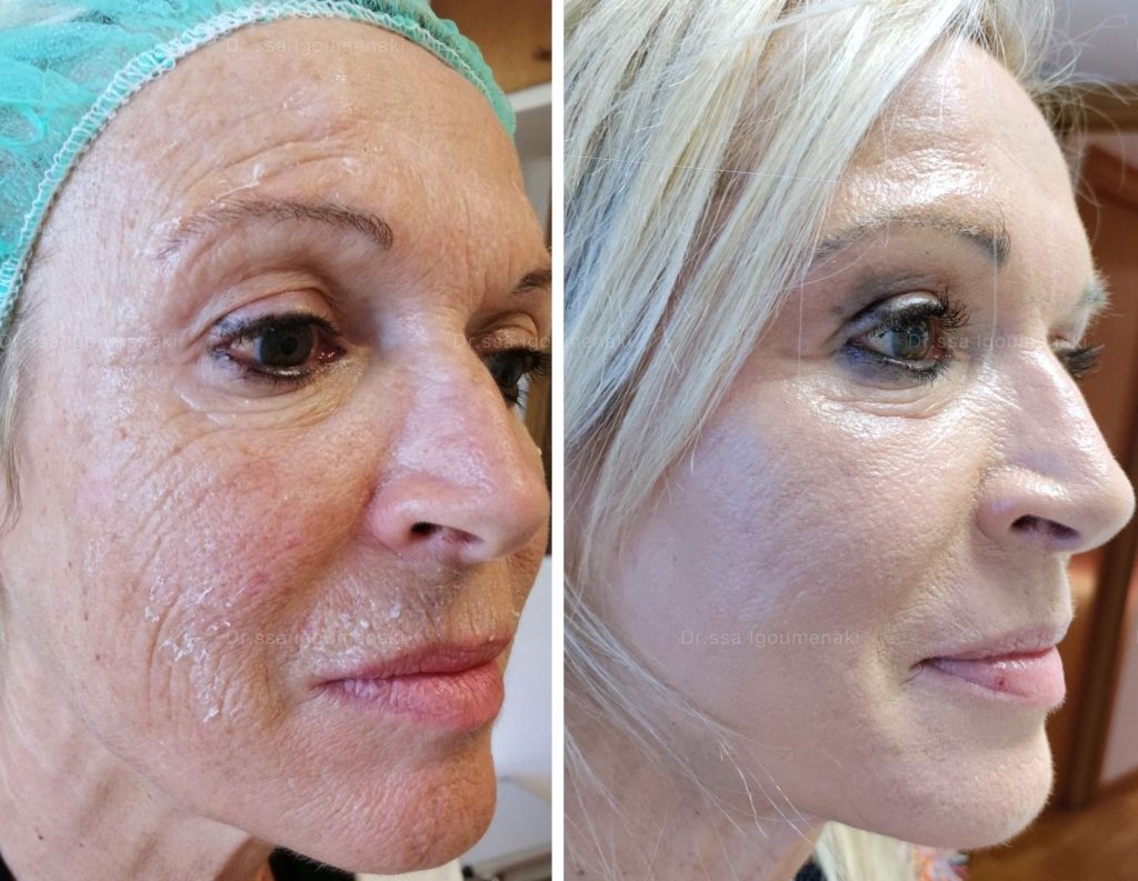 Blefaroplastica non Chirurgica Rimozione Rughe Roma